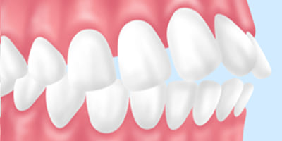 「出っ歯」が気になる【上顎前突（じょうがくぜんとつ）】
