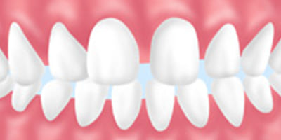 「すきっ歯」が目立つ【正中離開（せいちゅうりかい）】