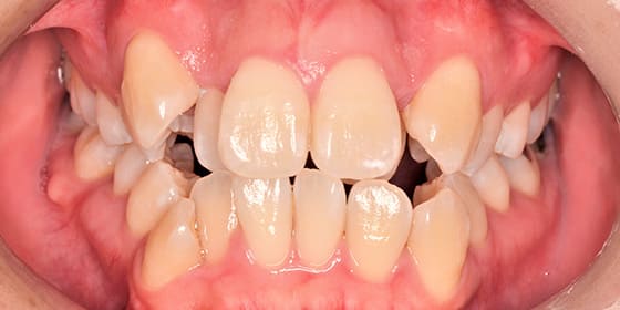 治療後の変化 Before