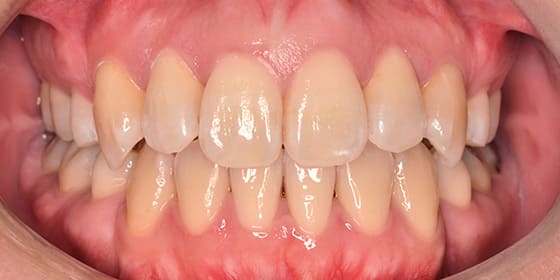 治療後の変化 After