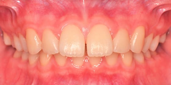 治療後の変化 Before