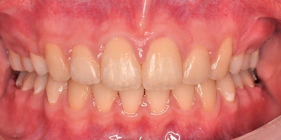 治療後の変化 After