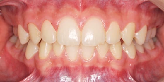 治療後の変化 After