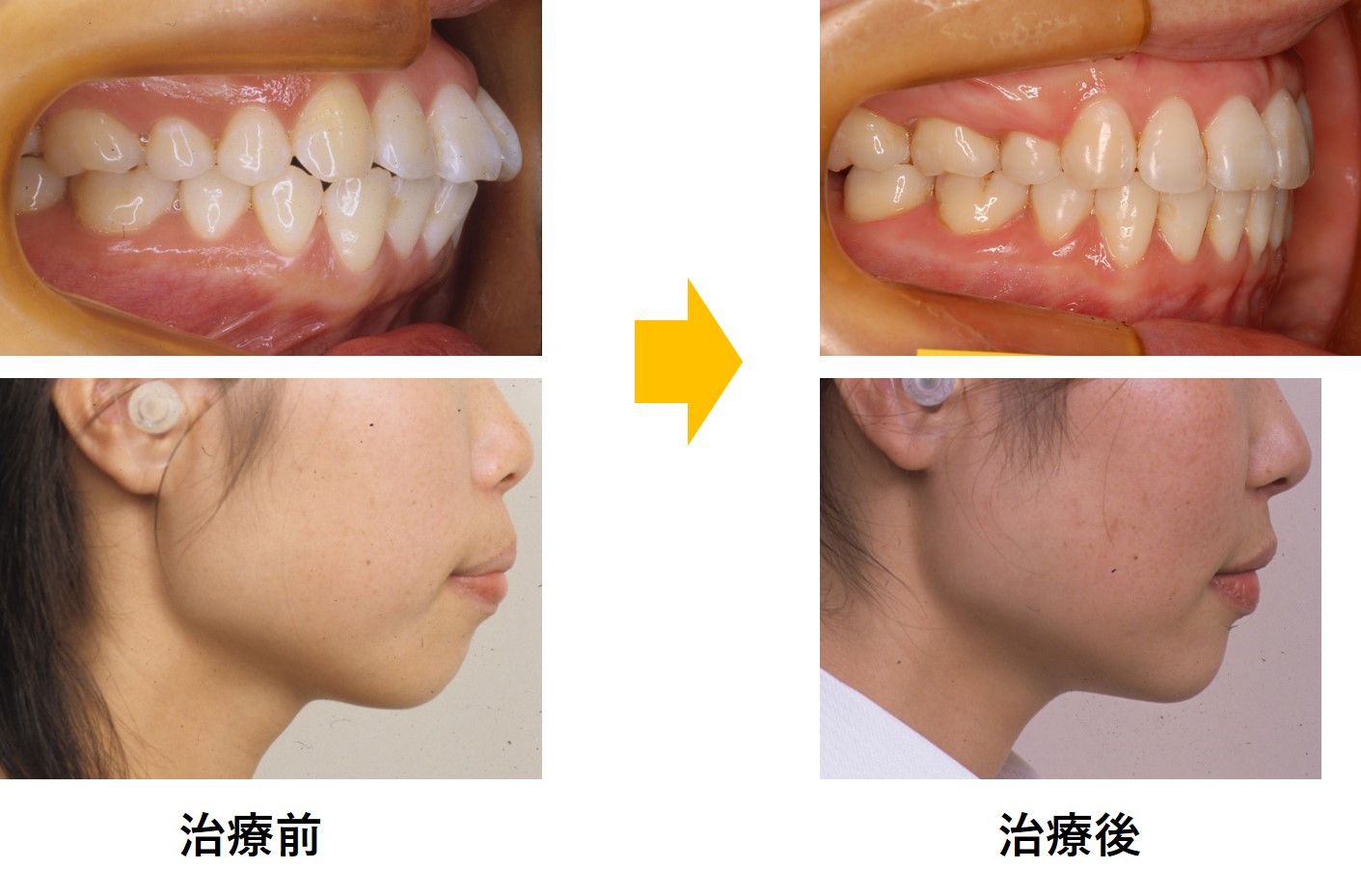 口元の改善について-横浜市旭区鶴ヶ峰の矯正歯科　くろかわ矯正歯科